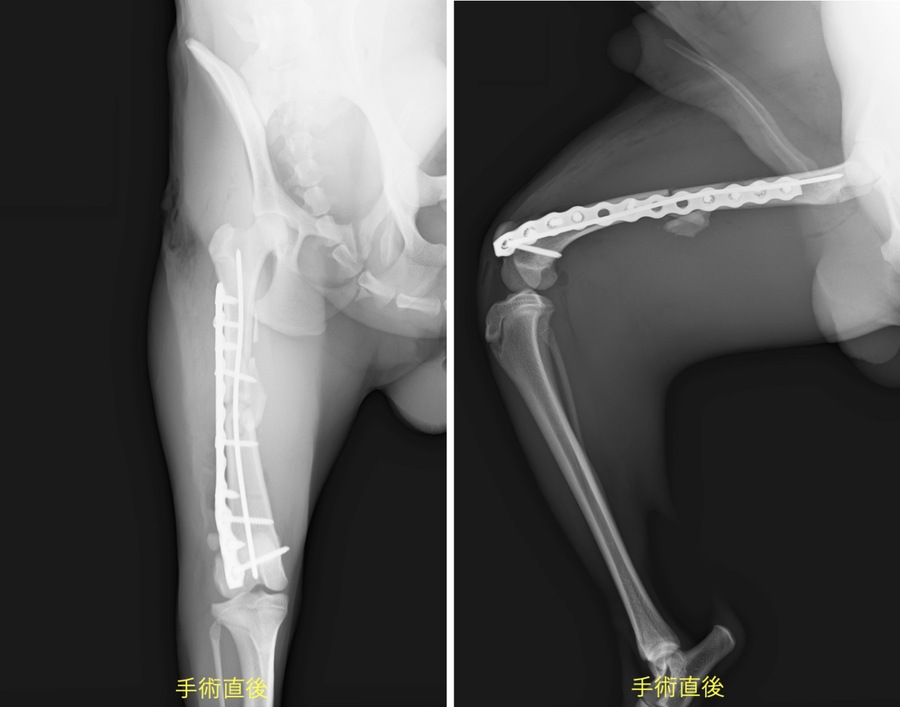 大腿骨転子部骨折の手術とリハビリの進め方。注意点についても解説 - かずぼーのリハビリ大全